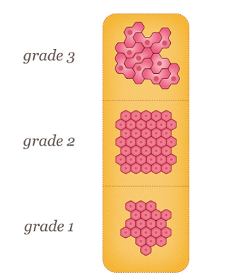 Click the link for a nifty little video on breast tumors, if that's your thing.